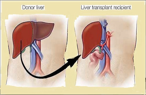 liver transplant liver transplant