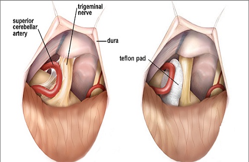 Microvascular Decompression Microvascular Decompression