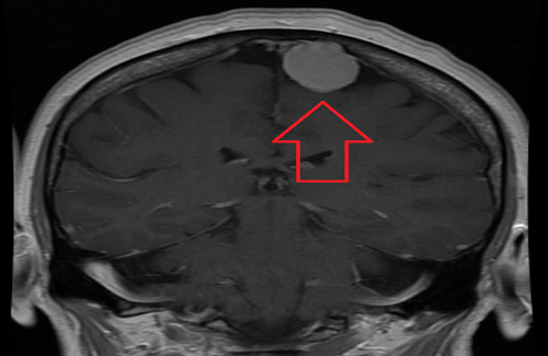 meningioma meningioma