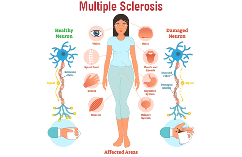 Multiple Sclerosis Multiple Sclerosis