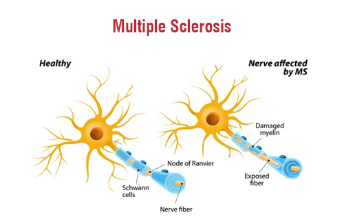 Multiple Sclerosis Multiple Sclerosis