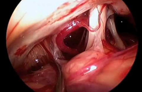 Microvascular Decompression Microvascular Decompression