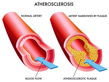 Need for Bypass Surgery
