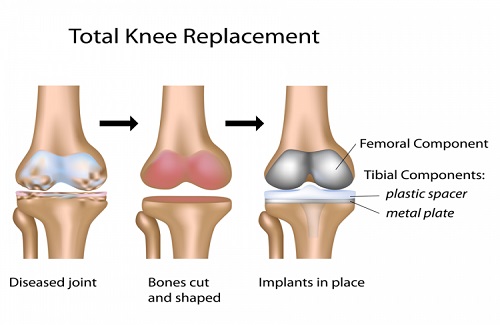 need of an orthopedic surgery need of an orthopedic surgery