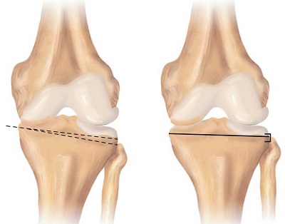 Osteotomy