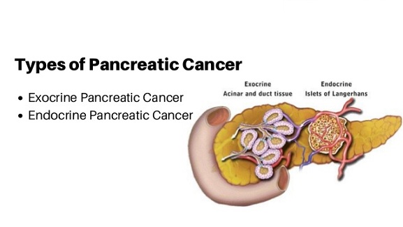 Types of pancreatic cancer