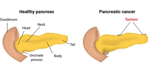 pancreatic cancer pancreatic cancer
