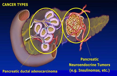 pancreatic cancer pancreatic cancer