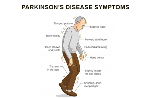 Parkinson's disease Parkinson's disease