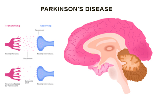 Parkinson's disease Parkinson's disease