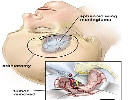 removal of brain tumor removal of brain tumor