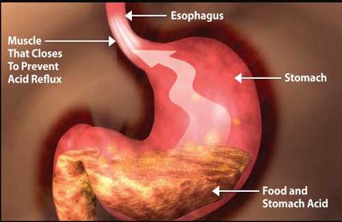 peptic ulcers peptic ulcers
