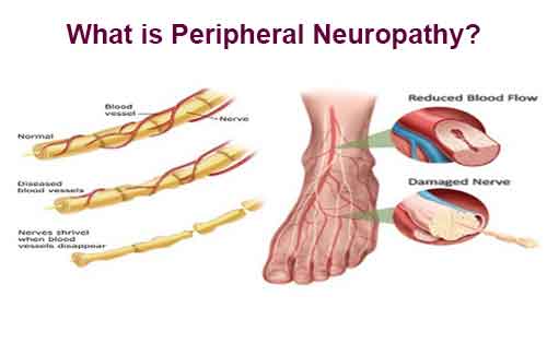 peripheral neuropathy