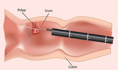 polypectomy