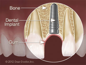 Post Implant