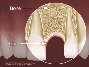 Pre Implant