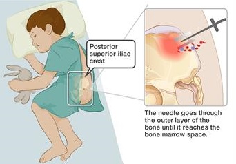 Preparation for Bone Marrow Transplant