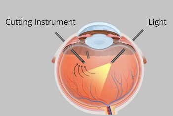Procedure of Vitrectomy