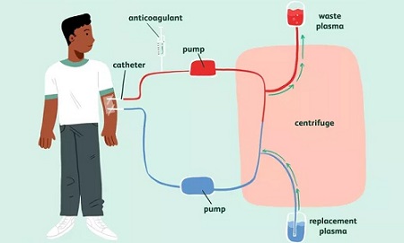 Process of Plasmapheresis