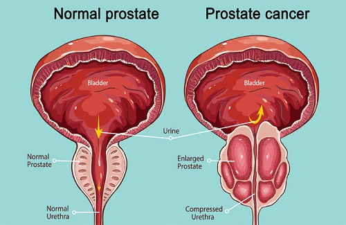 prostate cancer treatment cost in India prostate cancer treatment cost in India