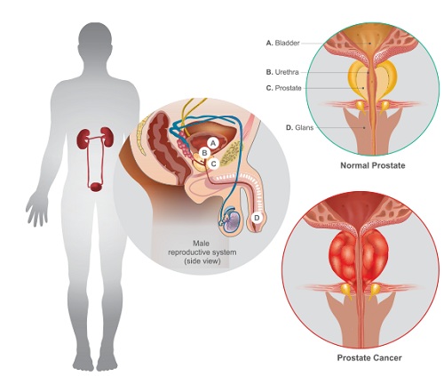 Prostate cancer treatment in India Prostate cancer treatment in India