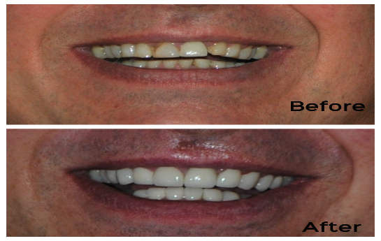 Randy Berthelette, USA, Dental Implants in India Randy Berthelette, USA, Dental Implants in India
