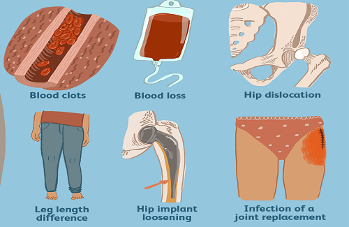 risks associated with knee replacement surgery risks associated with knee replacement surgery
