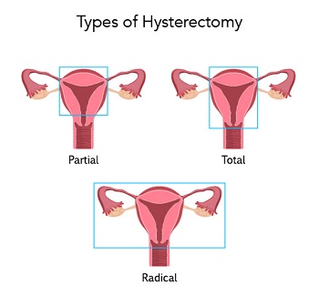 Types of Hysterectomy