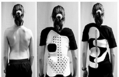 braces for scoliosis braces for scoliosis