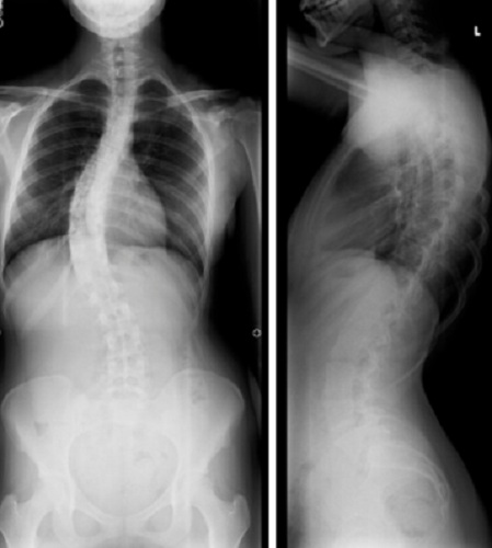 scoliosis