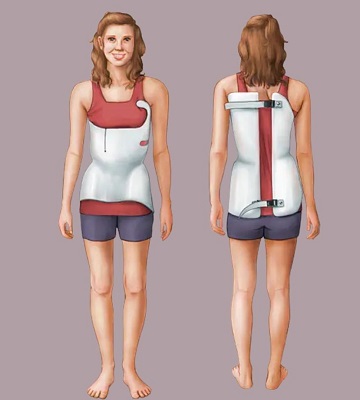 Scoliosis Treatment