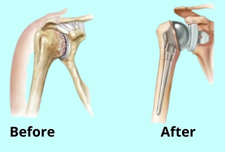 Shoulder Replacement