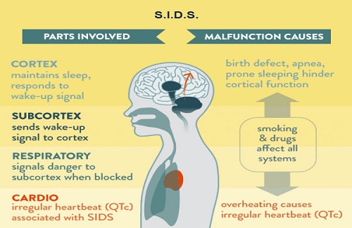 Sudden Infant Death Syndrome Sudden Infant Death Syndrome