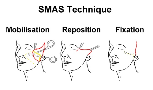face lift surgery