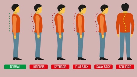 Spine Problems