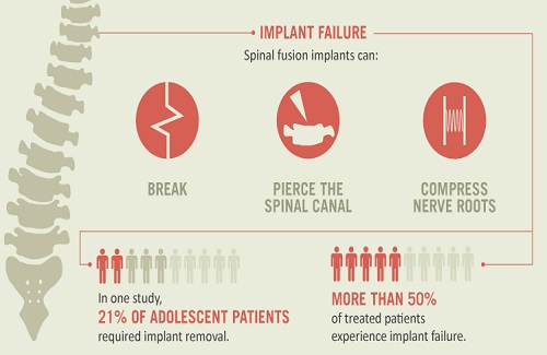 spine surgery risks and complications