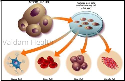 Risks of a bone marrow transplant