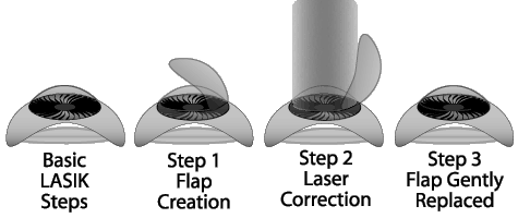 Steps in Lasik Surgery