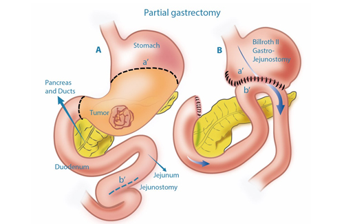 partial gastrectomy partial gastrectomy