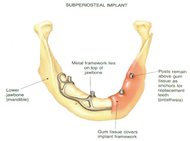 Subperiosteal Implants