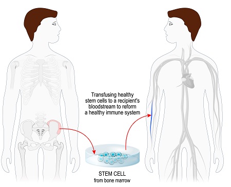 Procedure of BMT