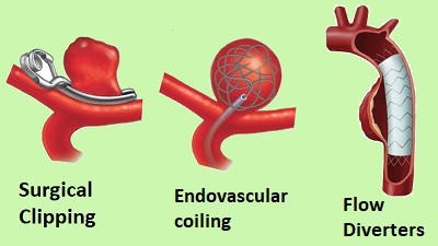 Treatment of Brain Aneurysm