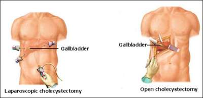 Types of Cholecystectomy