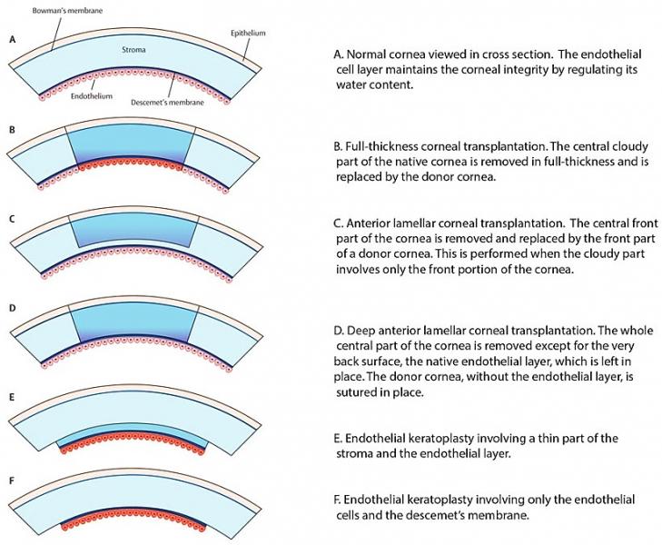 Types Of Corneal Surgery