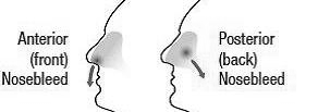 Types of Epistaxis
