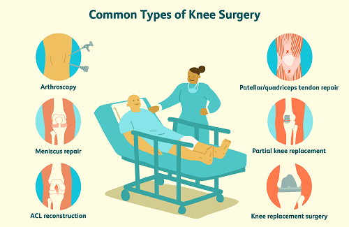 Types of knee replacement surgery in Turkey - Vaidam Types of knee replacement surgery in Turkey - Vaidam