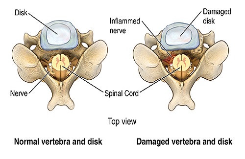 types of spine surgery types of spine surgery