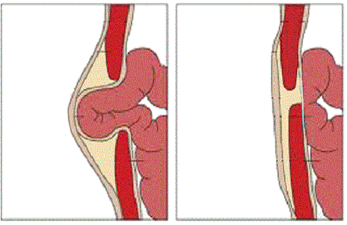 umbilical hernia umbilical hernia