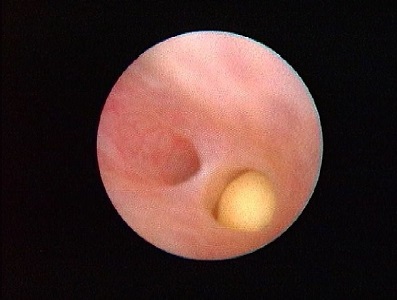 Stone in submandibular gland duct Stone in submandibular gland duct