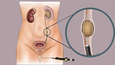 Ureteroscopy 